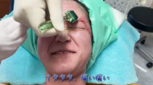 スキンニードリングの施術をリアルにレポート